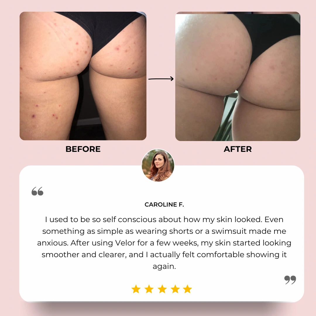 VÉLOR Butt Acne Cream