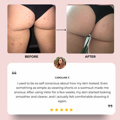 VÉLOR Butt Acne Cream