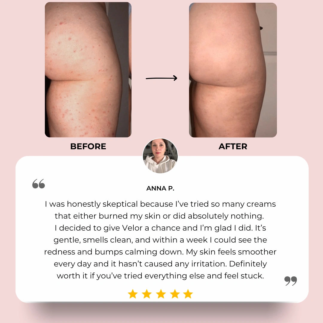 VÉLOR Butt Acne Cream