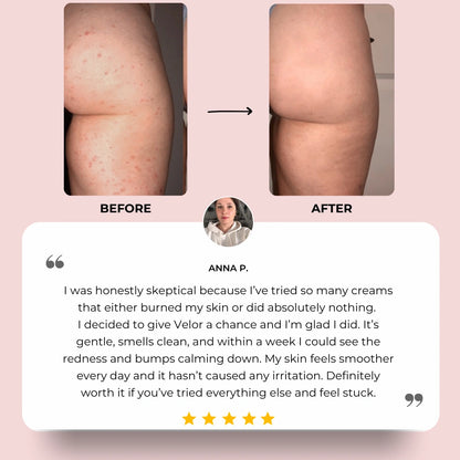 VÉLOR Butt Acne Cream