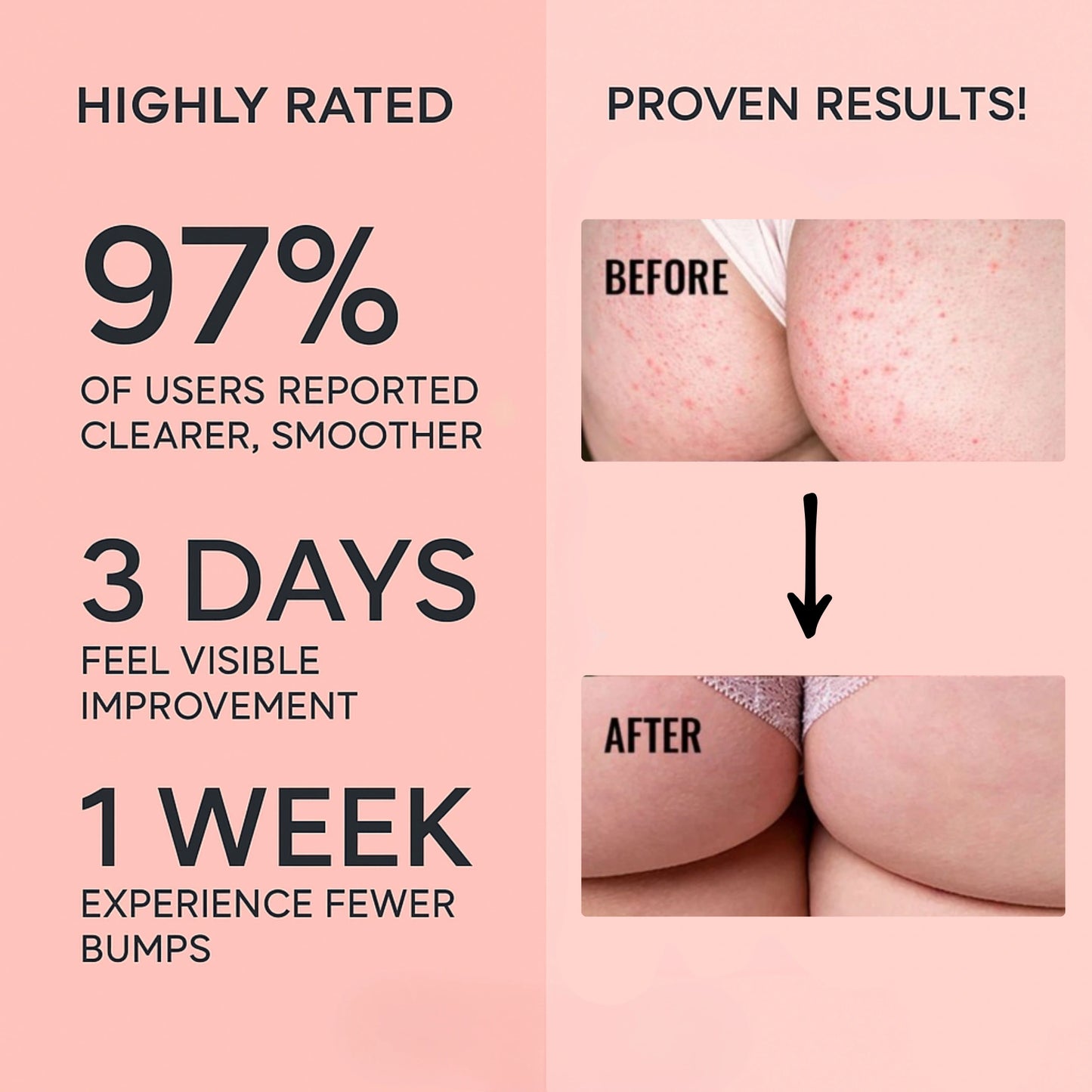 VÉLOR Butt Acne Cream